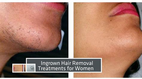 Laser Hair Removal Miami Before And After Results Youtube