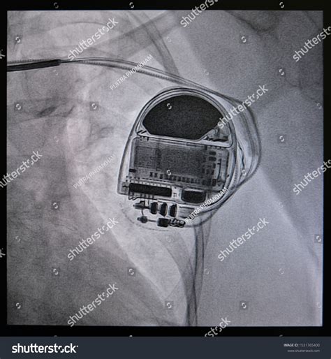 X Ray Image Permanent Pacemaker Implantation Foto De Stock