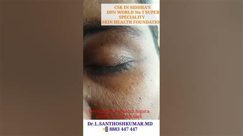 Dpn Face Black Dots Poga Natural Medicine Face Black Dots Dpn Tamil