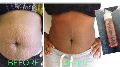 How To Get Rid Of Stretch Marks And Scars Fast Youtube