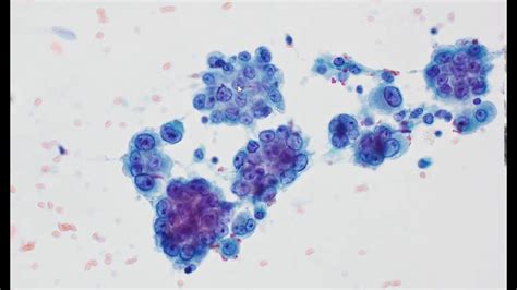 Mesothelioma Cytology Youtube
