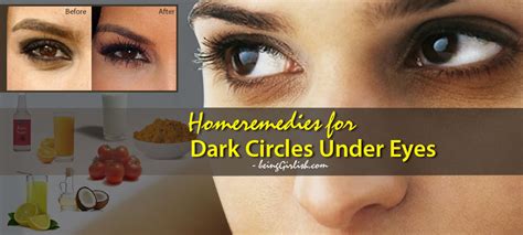 Best Home Remedies For Dark Circles Under Eyes Being Girlish