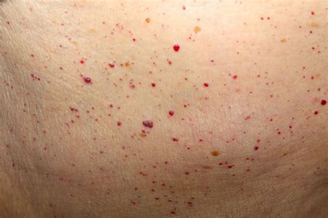 Trending Home 616tch Tiny Red Dots On Skin From Sun