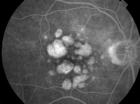How To Interpret Fluorescein Angiography 6 Types Of Defects Eyeguru