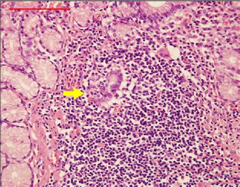 Figure 1 From Diagnosis And Treatment Of Gastric Malt Lymphoma