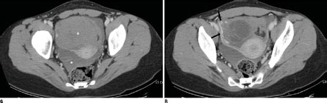 Figure 3 From Ct Imaging Findings Of Ruptured Ovarian Endometriotic