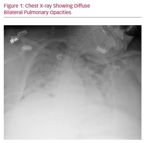 Chest X Ray Showing Diffuse Bilateral Pulmonary Opacities Radcliffe