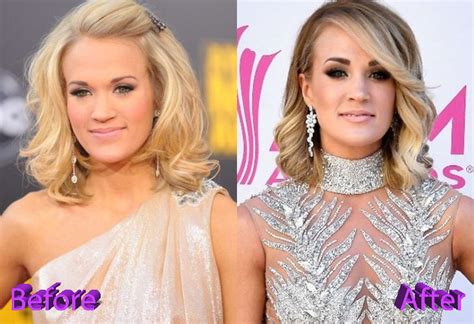 Carrie Underwood Plastic Surgery Looking Better Than Ever