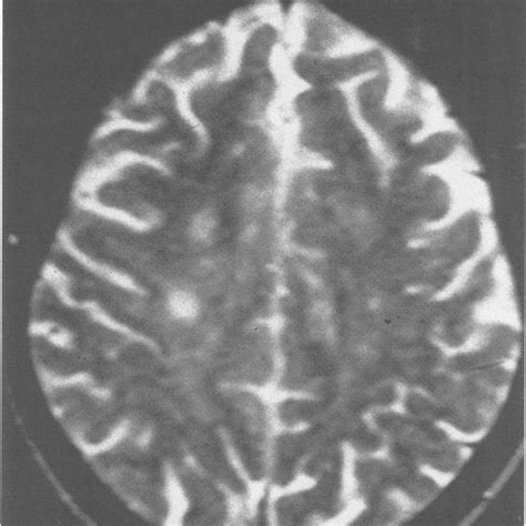 Mri T2 Weighted Image Showing Hemispheric White Matter Lesions