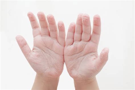 Pruned Or Wrinkled Fingers Causes And Treatments Skincarederm