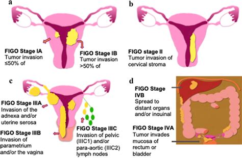 Illustrated Figo Staging System For Endometrial Cancer A Stage