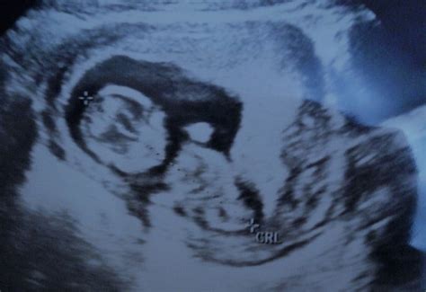 Gambar Bayi Di Dalam Kandungan 3 Bulan Adzka