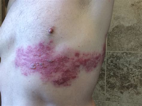 My Personal Experience with Severe Herpes Zoster (Shingles) and Long