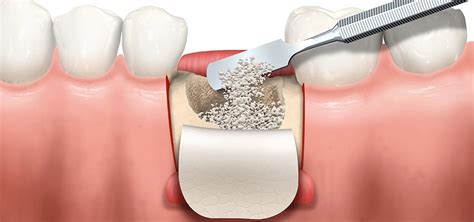 Injerto óseo dental Cirugía paso a paso riesgos y recuperación