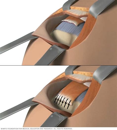 Rotator Cuff Injury Diagnosis And Treatment Mayo Clinic