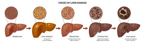 Diagram Of Liver Cirrhosis Cirrhosis Free Vector Art 23 Free