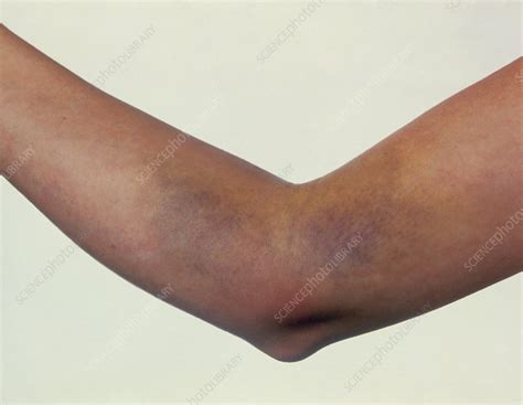 Bruising On Womans Arm After Blood Test Stock Image M3300375