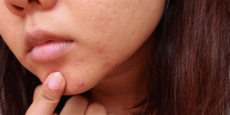 What To Know About Treating Cystic Acne Per Dermatologists Popsugar Beauty Uk