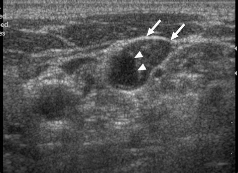 Transverse Sonogram Showing A Lymph Node Involved With Mycobacterial