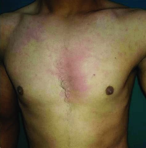 Allergic Contact Dermatitis Of The Chest From A Perfume Spray