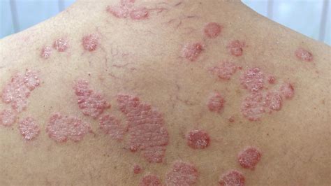 Psoriasis Rash What It Looks Like And How To Deal Laptrinhx News