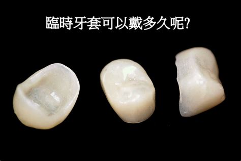 臨時牙套可以戴多久？ 高雄根管治療專家 牙髓病專科王俊欽牙醫師