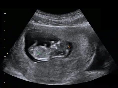 11 неделя беременности фото живота УЗИ и вес плода боли и выделения