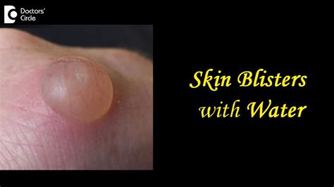 Skin Blisters With Water Causes Treatment Draining Prevention Dr