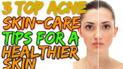 3 Top Acne Skin Care Tips For A Healthier Skin Natural Cures