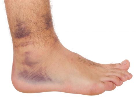 What Are The Symptoms Of A Blood Clot In The Foot