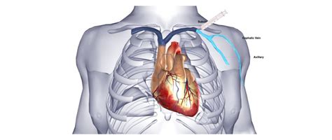 Defibrillator Aicd Implantation One Heart Cardiology