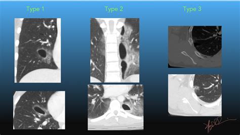 Parenchymal Injuries Of The Lung Uw Emergency Radiology