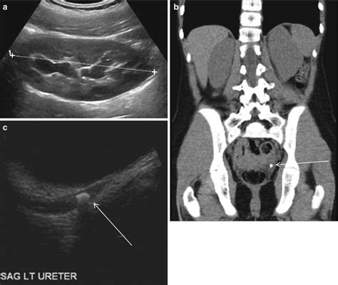 Renal Imaging Hydronephrosis And Renal Obstruction Radiology Key