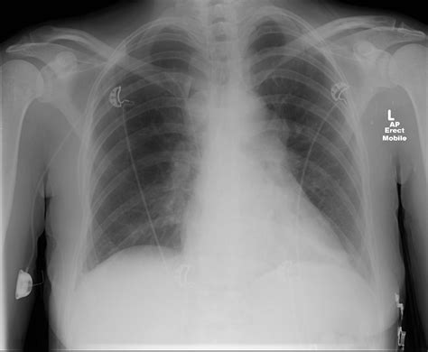 Thoracic Lymphadenopathy On Chest X Ray Image
