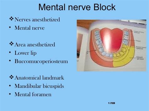 Local Anesthesia