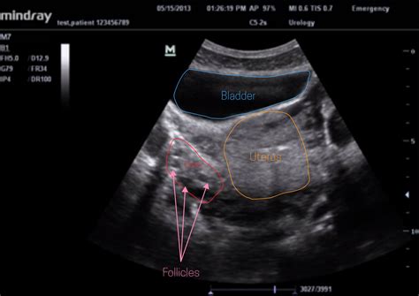 Ultrasound Leadership Academy The Basics Of Pelvic Transabdominal