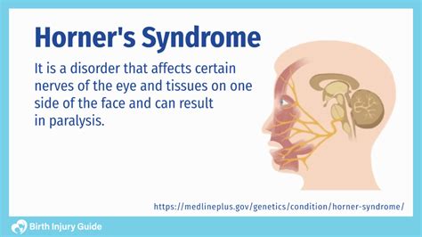 Horner S Syndrome Causes Symptoms And Treatment