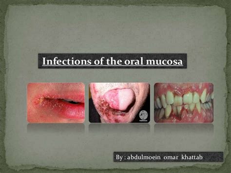 Infection Of Oral Mucosa