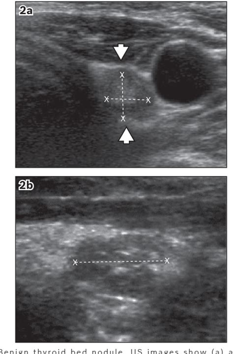 Figure 2 From Post Thyroidectomy Neck Ultrasonography In Patients With Thyroid Cancer And A