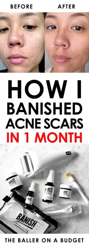 Banish Acne Scars Product Review My Professional Life With Acne
