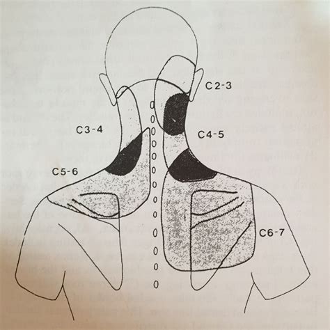 Areas Of Referred Pain Cervical Spine Spinecare Medical Group