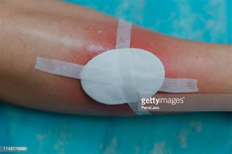 Eczema Blisters Photos And Premium High Res Pictures Getty Images