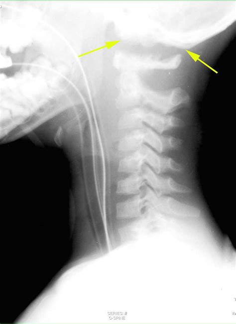 Occiput C1 Separation On X Ray X Rays Case Studies Ctisus Ct Scanning