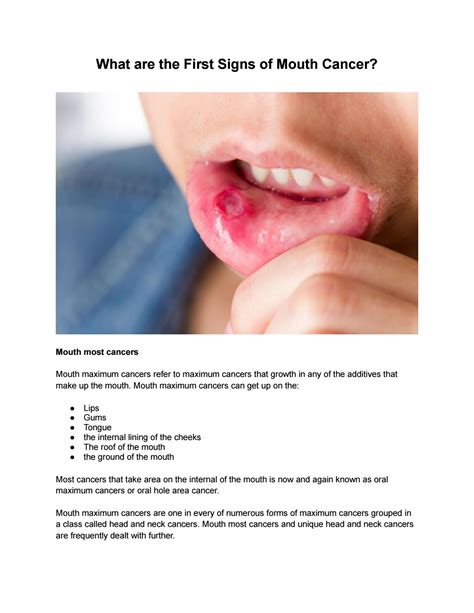 Mouth Cancer What It Is Symptoms Motives And Prevention — Your Health