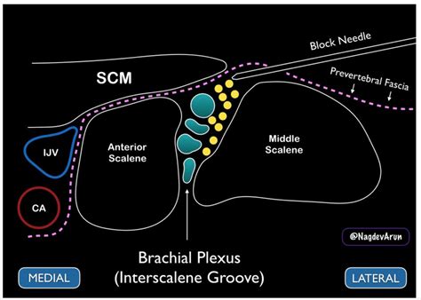 Brachial Plexus Nerve Block