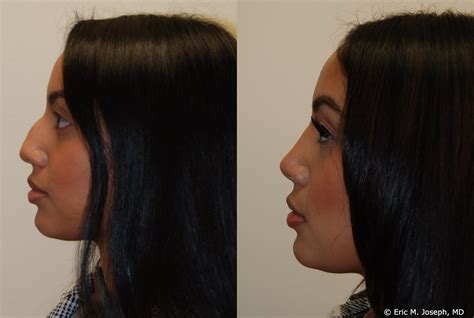 Eric M Joseph Md Rhinoplasty Before After Hump Removal And Tip Narrowing
