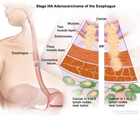 Esophageal Cancer Treatment Adult PDQ Patient Version Siteman