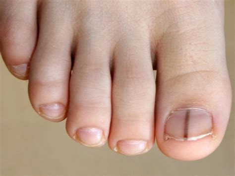 Gelukkig bestaan er diverse huishoudmiddelen om zwarte schimmel succesvol te verwijderen, zoals boraxpoeder, bleek, tea tree olie, azijn, soda en waterstofperoxide. Nagelchirurgie - Roosevelt Kliniek