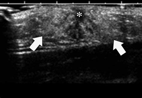 Breast Masses In Children And Adolescents Radiologic Pathologic