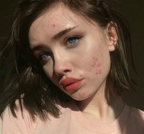 Teenager Shares Makeup Free Acne Selfies To Help Other People
